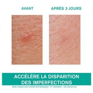 Uriage Hyséac Pâte SOS – Soin Local 15 g 03Parapharm - Algérie, Beauté, Santé , Bien-être...